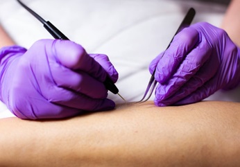 Why choose electrolysis for permanent hair removal?